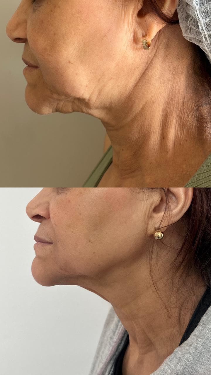 Antes e depois de Hi Pro na região do pescoço