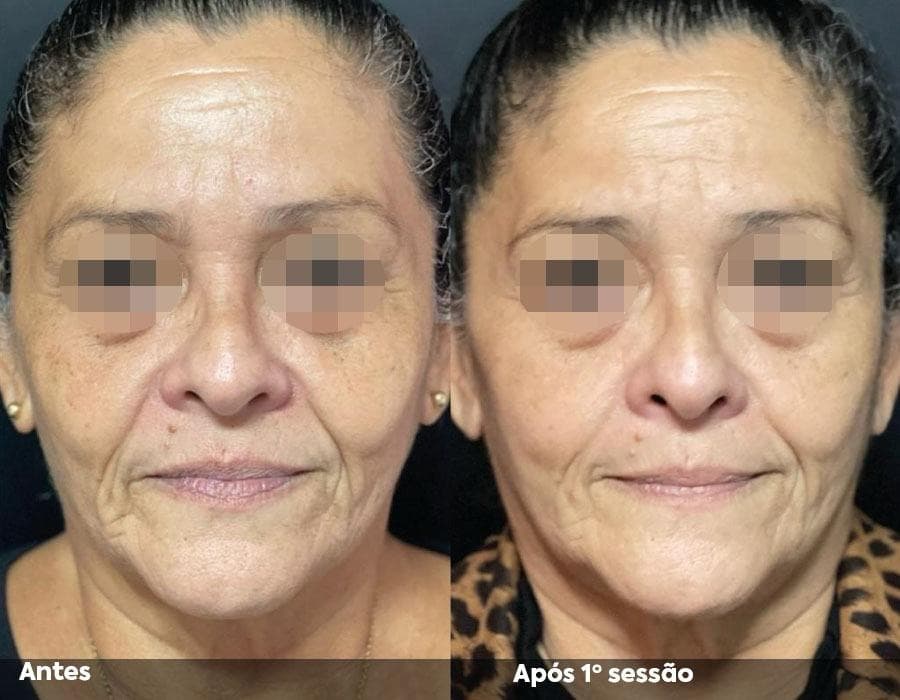Resultado frontal de Hi Pro após uma sessão