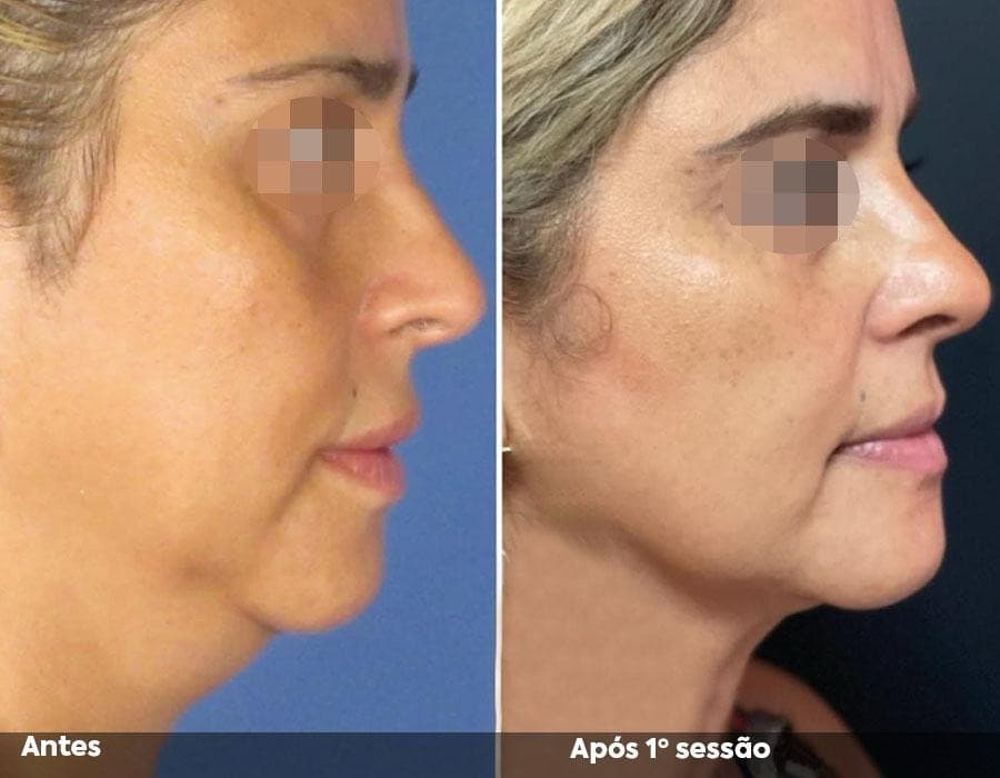 Resultado de Hi Pro em perfil do rosto após uma sessão