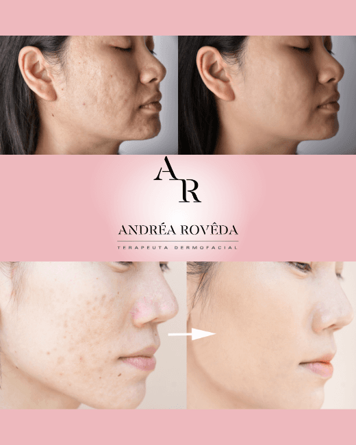 Cuidado estético para pele acneica na Andrea Roveda Estética