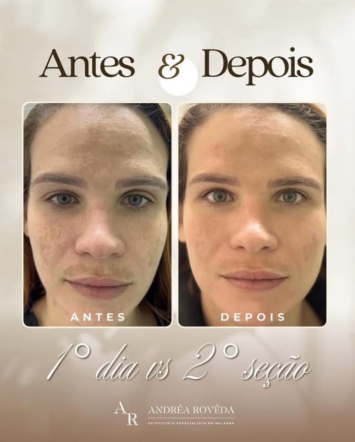 Registro de acompanhamento do controle de melasma com comparação antes e depois no 10º dia e após a 2ª sessão
