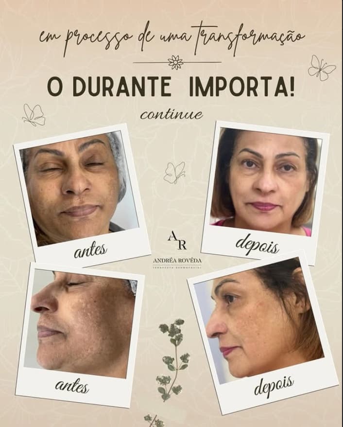 Registro de acompanhamento de manchas no rosto em diferentes ângulos, antes e depois