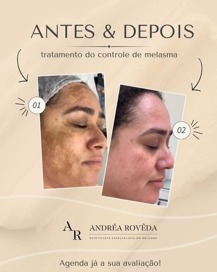 Registro de acompanhamento do controle de melasma em perfil, antes e depois