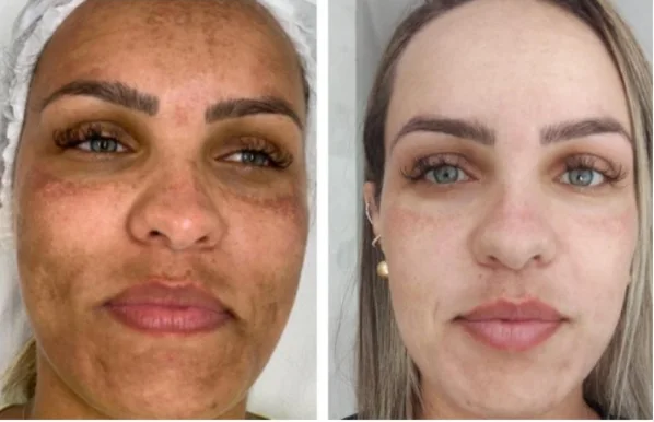 Comparação antes e depois de acompanhamento para melasma em vista frontal