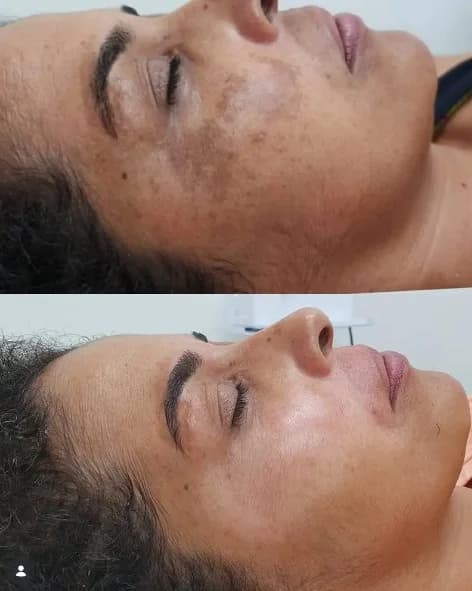 Comparação antes e depois de acompanhamento para melasma em perfil deitada
