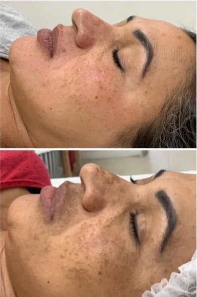 Antes e depois de cuidado para melasma em perfil com olhos fechados