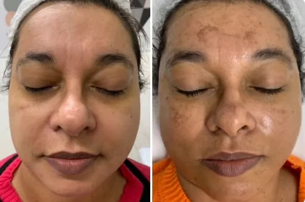 Antes e depois de acompanhamento para melasma em rosto frontal