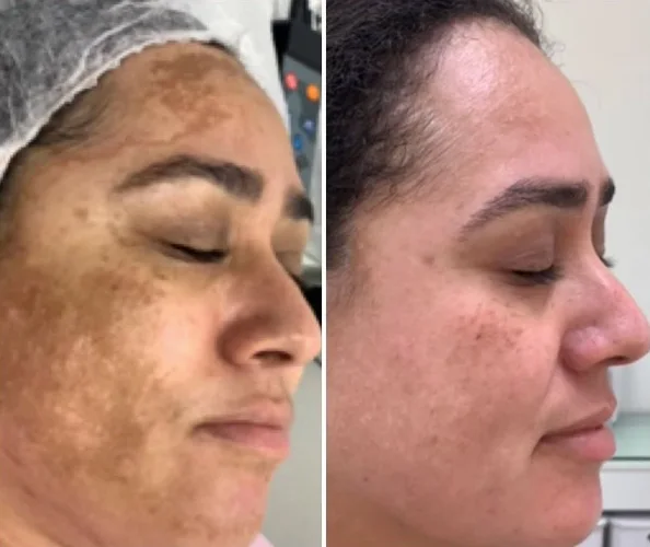 Comparação lateral antes e depois de cuidado estético para melasma