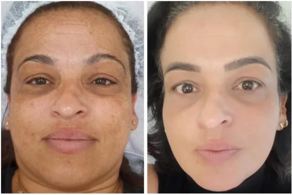 Antes e depois de acompanhamento para melasma em rosto de frente