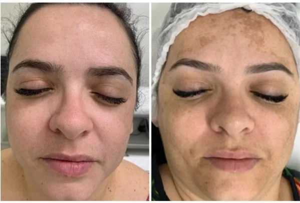 Comparação antes e depois de manchas de melasma na testa e no rosto