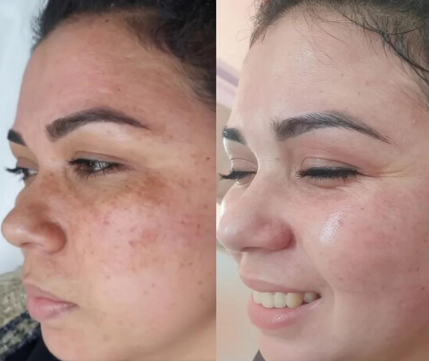 Antes e depois de cuidado para melasma em vista lateral sorrindo